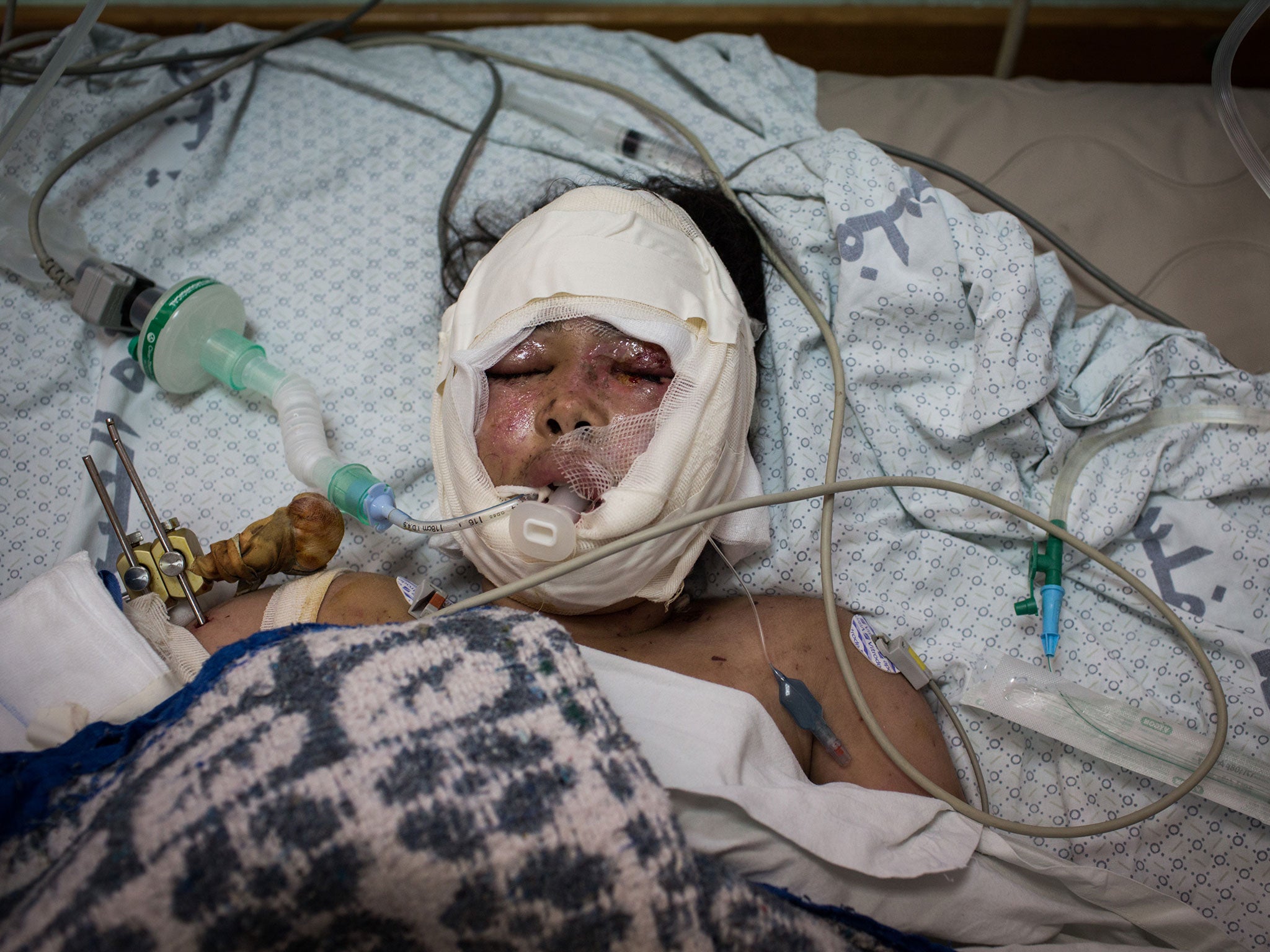 Hanine Al Bakri, 9, pictured in the burns unit of Shifa Hospital, in Gaza city. Hanine was injured along with her sister, Yasmine, after an Israeli attack on Shati refugee camp in Gaza city