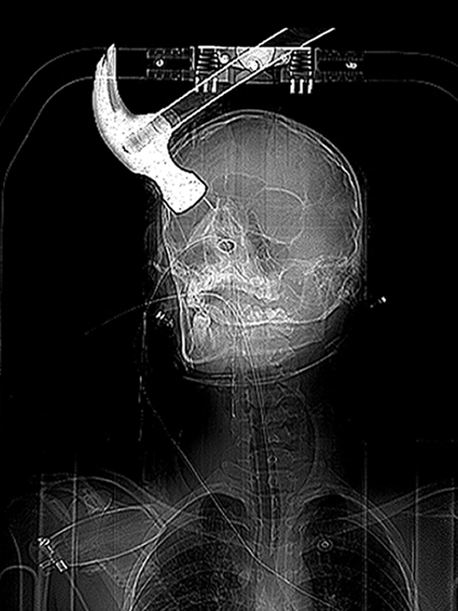 An x-ray of Mr Huntley's skull after he was attacked with a claw hammer