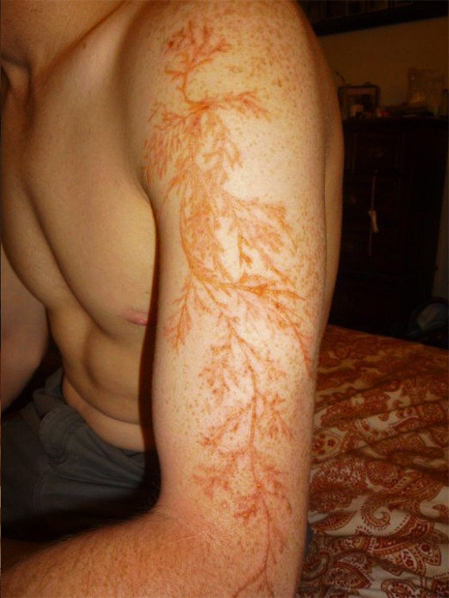 The pink and brown frond-like bruises experienced by lightning survivors (credit geardiary.com)