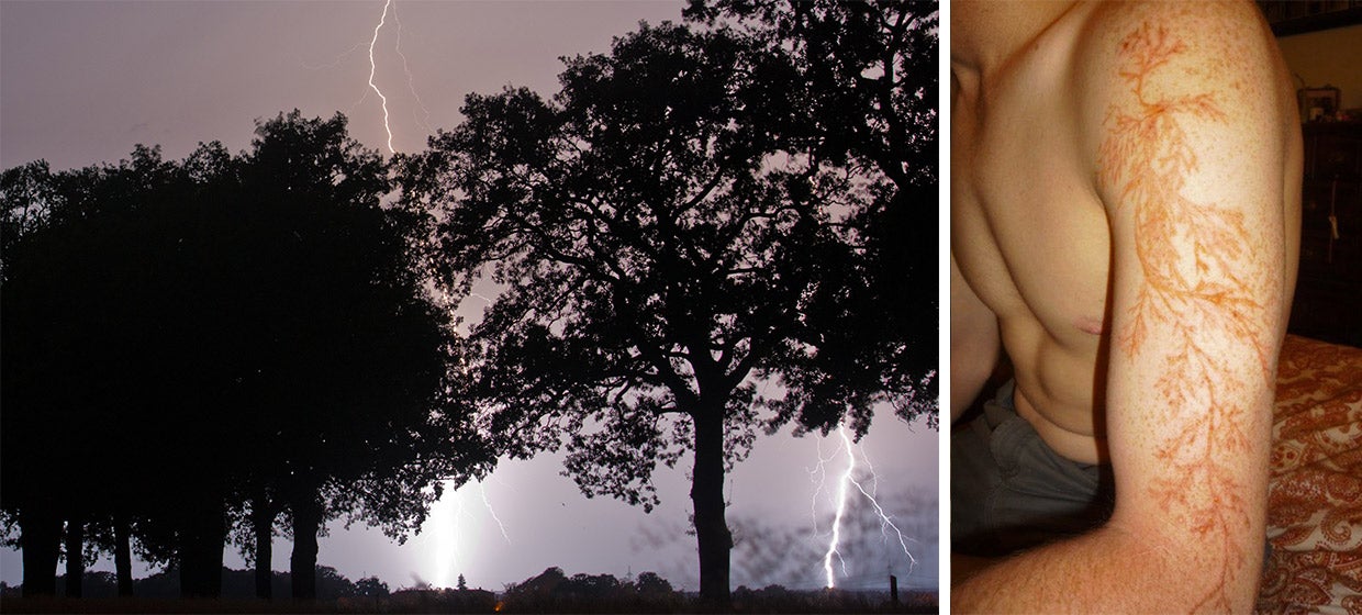 Lightning strikes over an alley in Germany; The pink and brown frond-like bruises experienced by lightning survivors