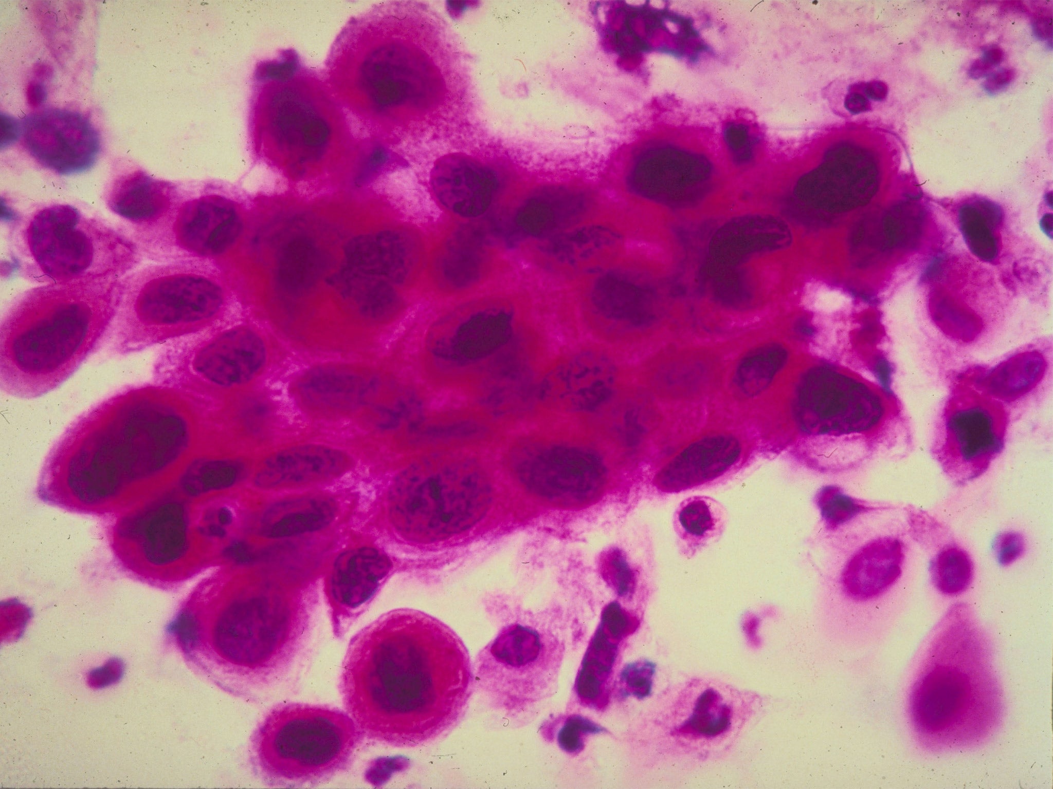 New cervical cancer test for human pappilomavirus will reduce need to look for abnormal cells