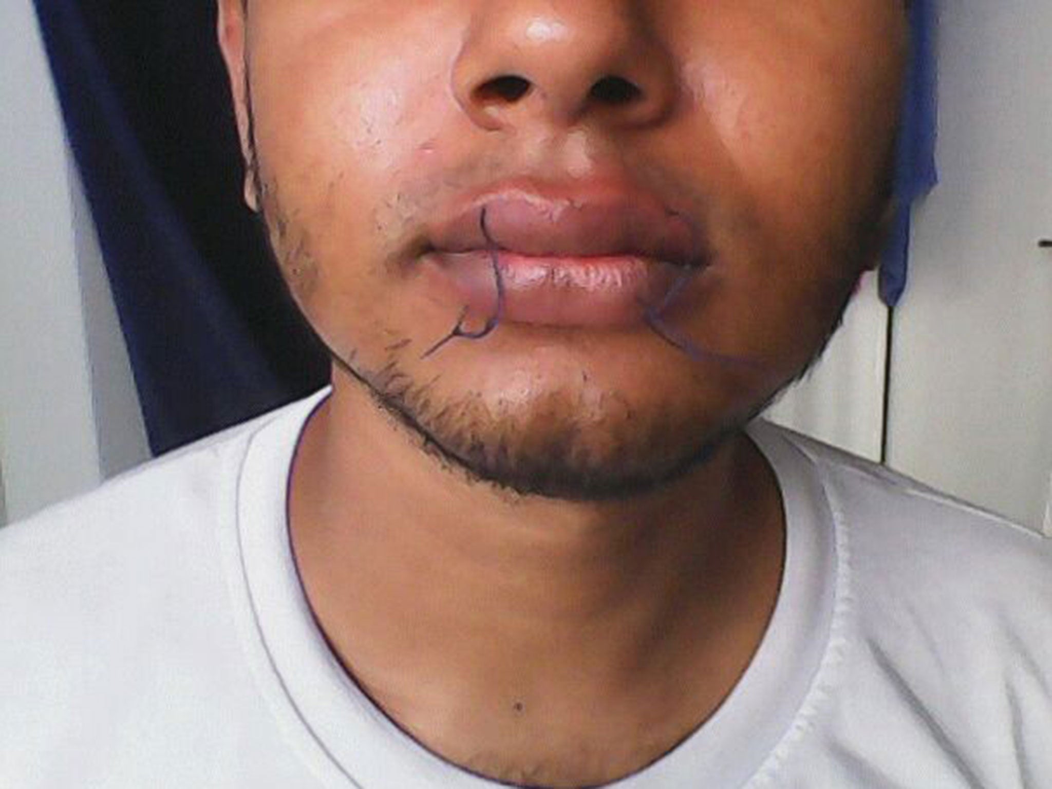 An asylum seeker with his lips sewn together