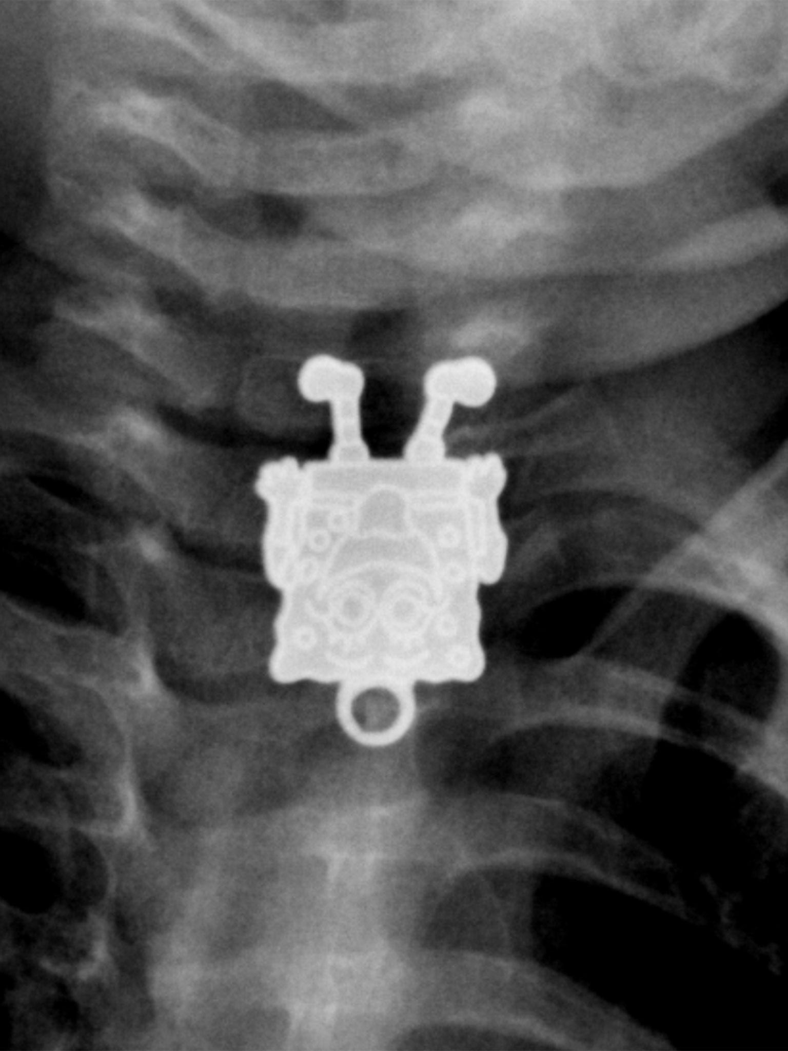 Upside down "SpongeBob SquarePants" swallowed by a 16-month-old baby. Case courtesy of Dr Ghofran Ageely, Radiopaedia.org