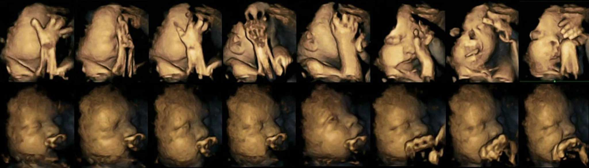 The top set of images show the baby in a womb of a smoking mother, compared to one whose mother was not a smoker