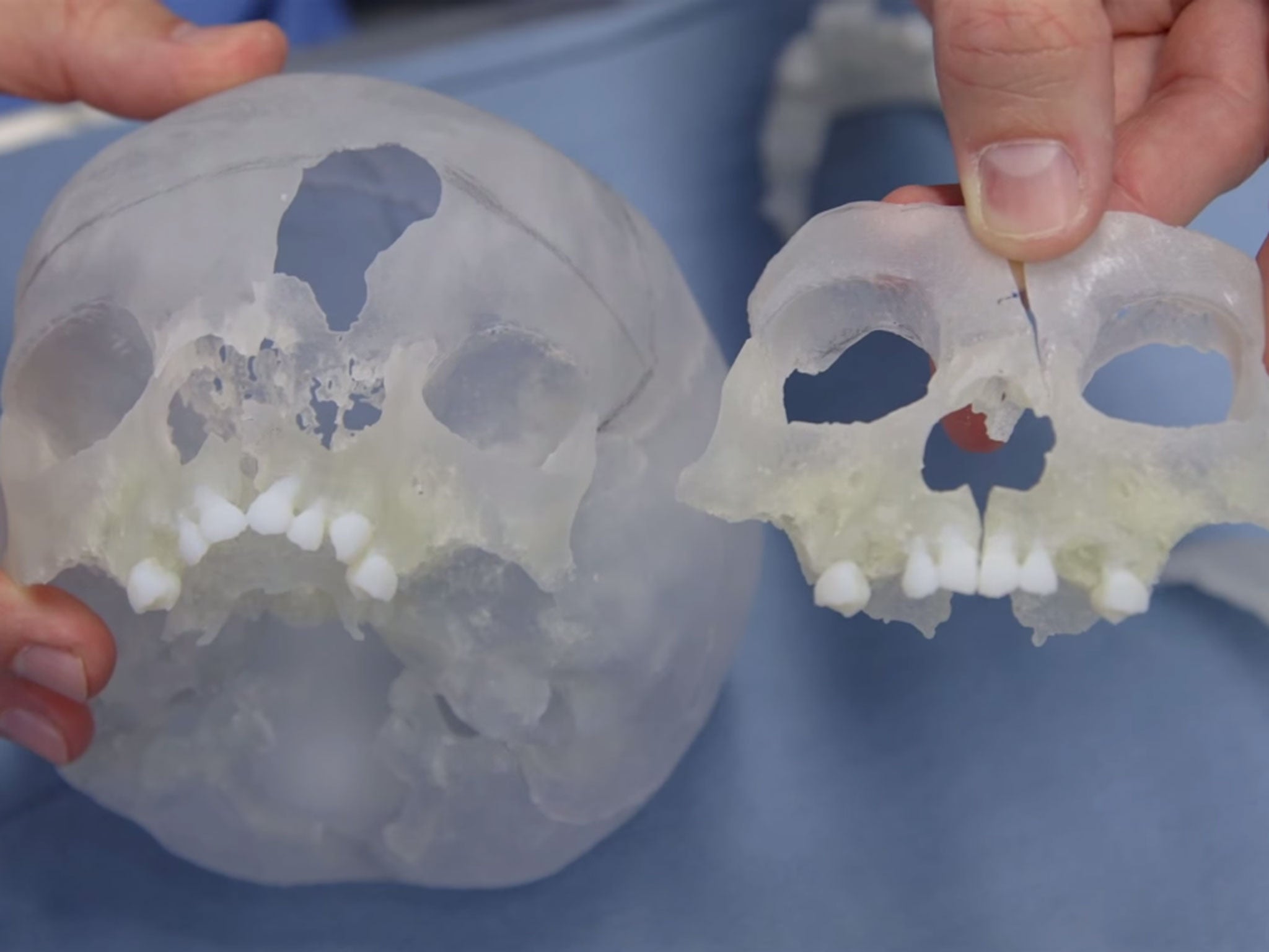 The 3D models which surgeons used to reconstruct Violet's face