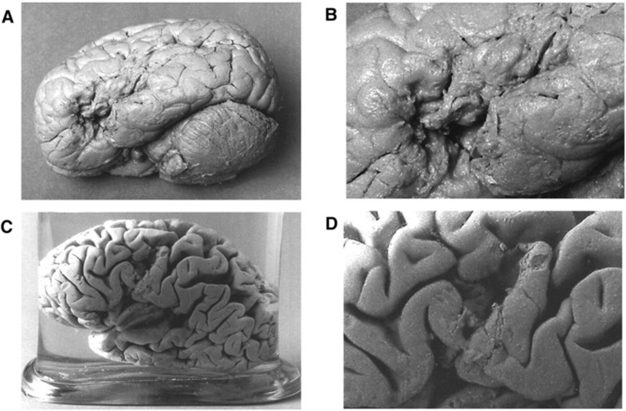 Leborgne (A,B) meet Lelong (C,D) - (Brain: A Journal of Neurology)