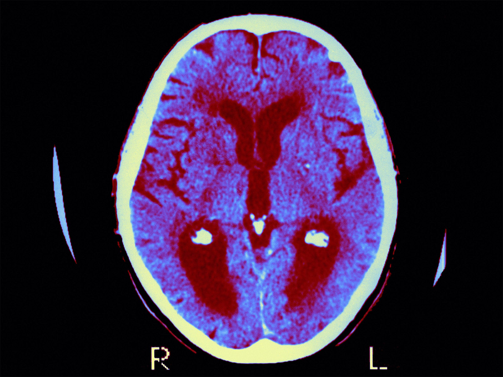 Only a costly and invasive brain scan or spinal tap procedure can accurately detect early build-up of Alzheimer’s-causing molecule