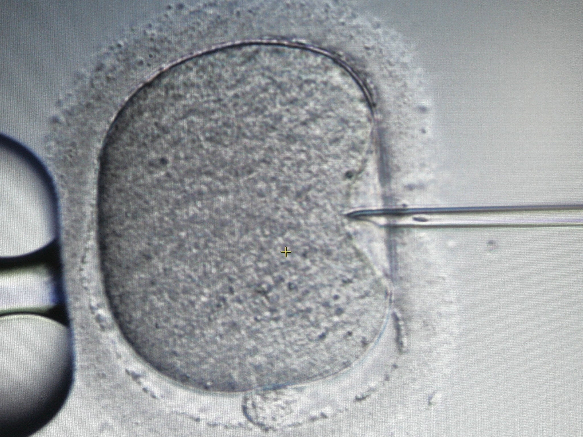 50,000 women undergo IVF treatment in Britain every year