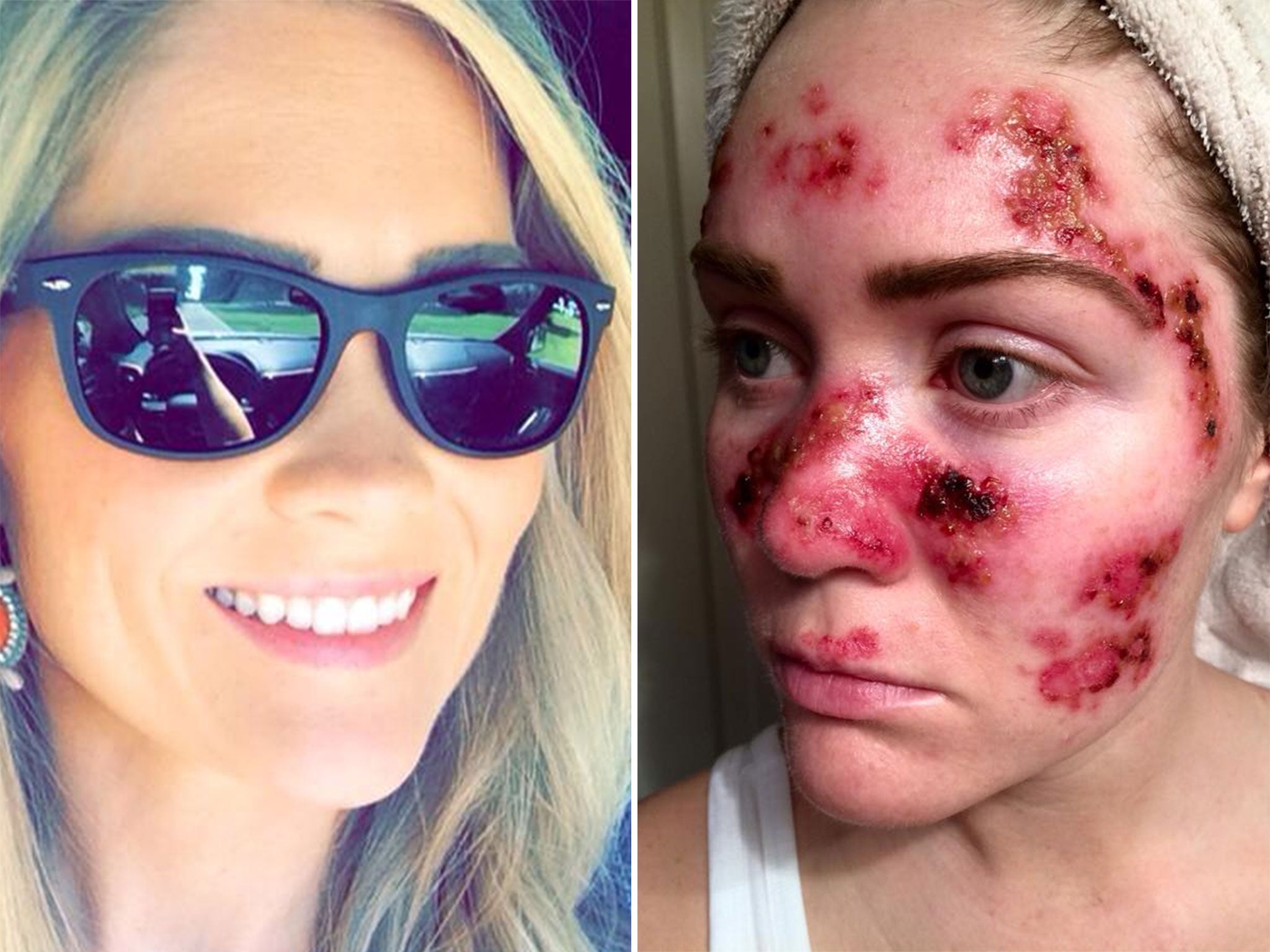 Tawny Willoughby posted her skin cancer treatment image to Facebook - and it has been shared more than 55,000 times