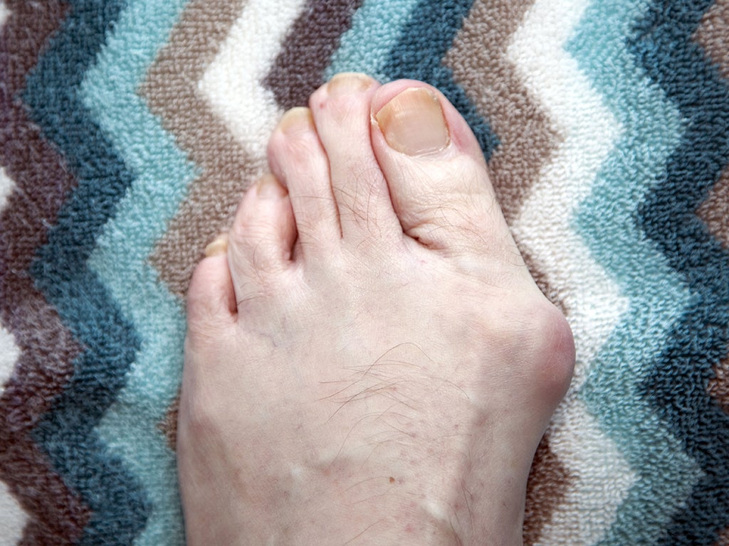 A bunion (hallux valgus) is a deformity of the big toe joint sometimes needing surgery