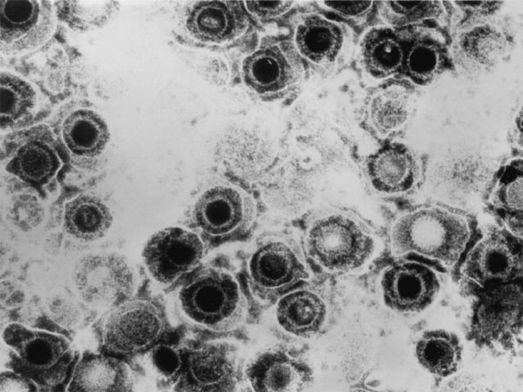 Micrograph of a herpes simplex virus. Scientists have hailed the breakthrough as 'exciting'