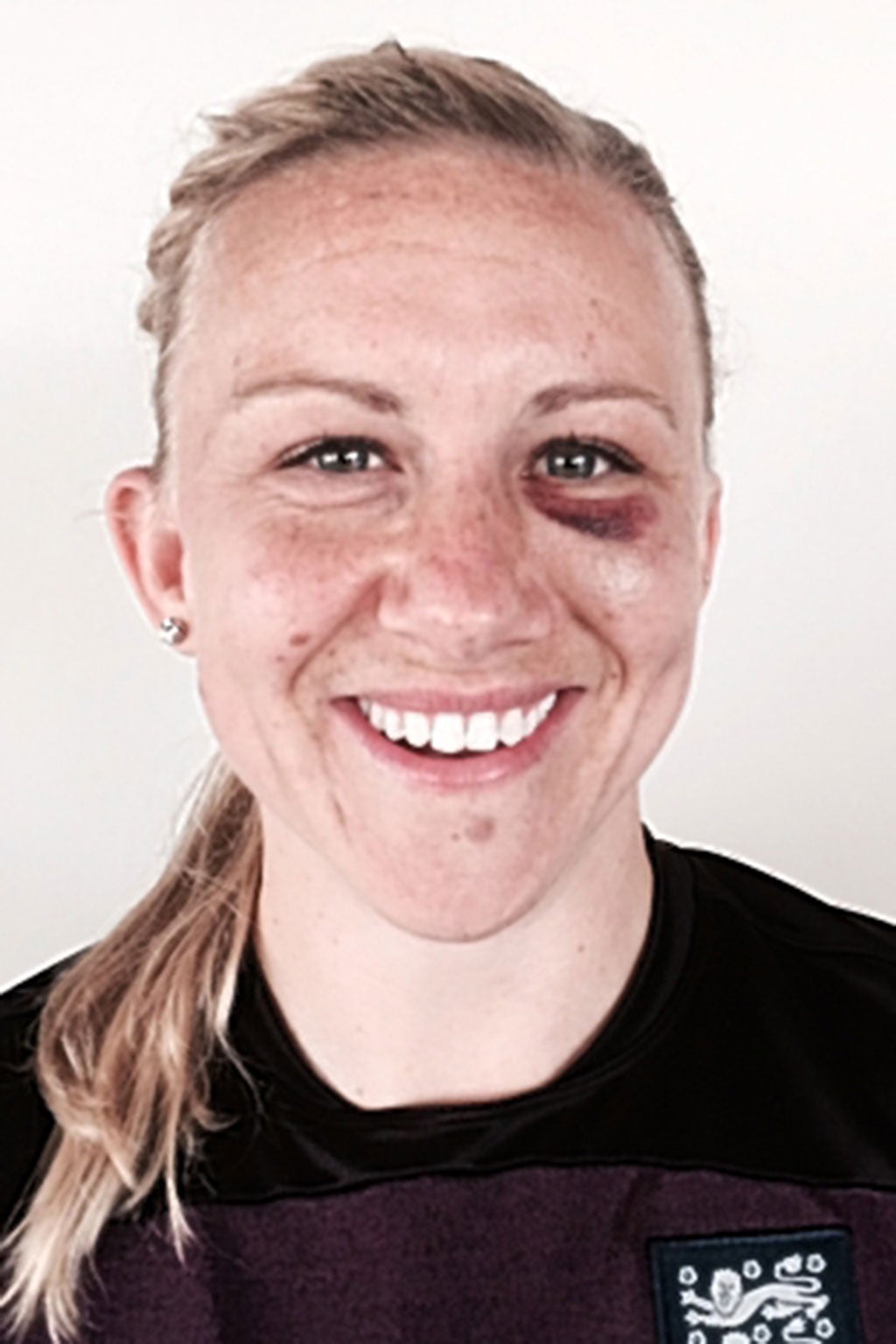 Laura Bassett smiles despite the swelling under her eye