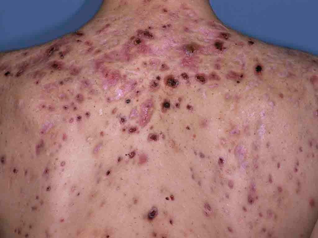 &#13;
Severe Acne on skin of the human back &#13;