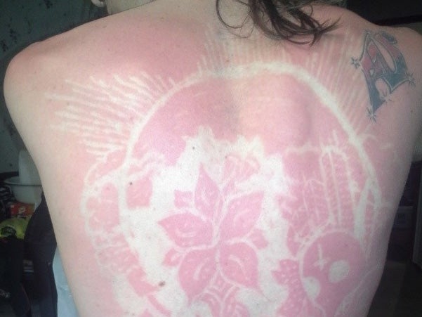 'Sunburn art' internet trend has raised concerns of cancer risk among doctors