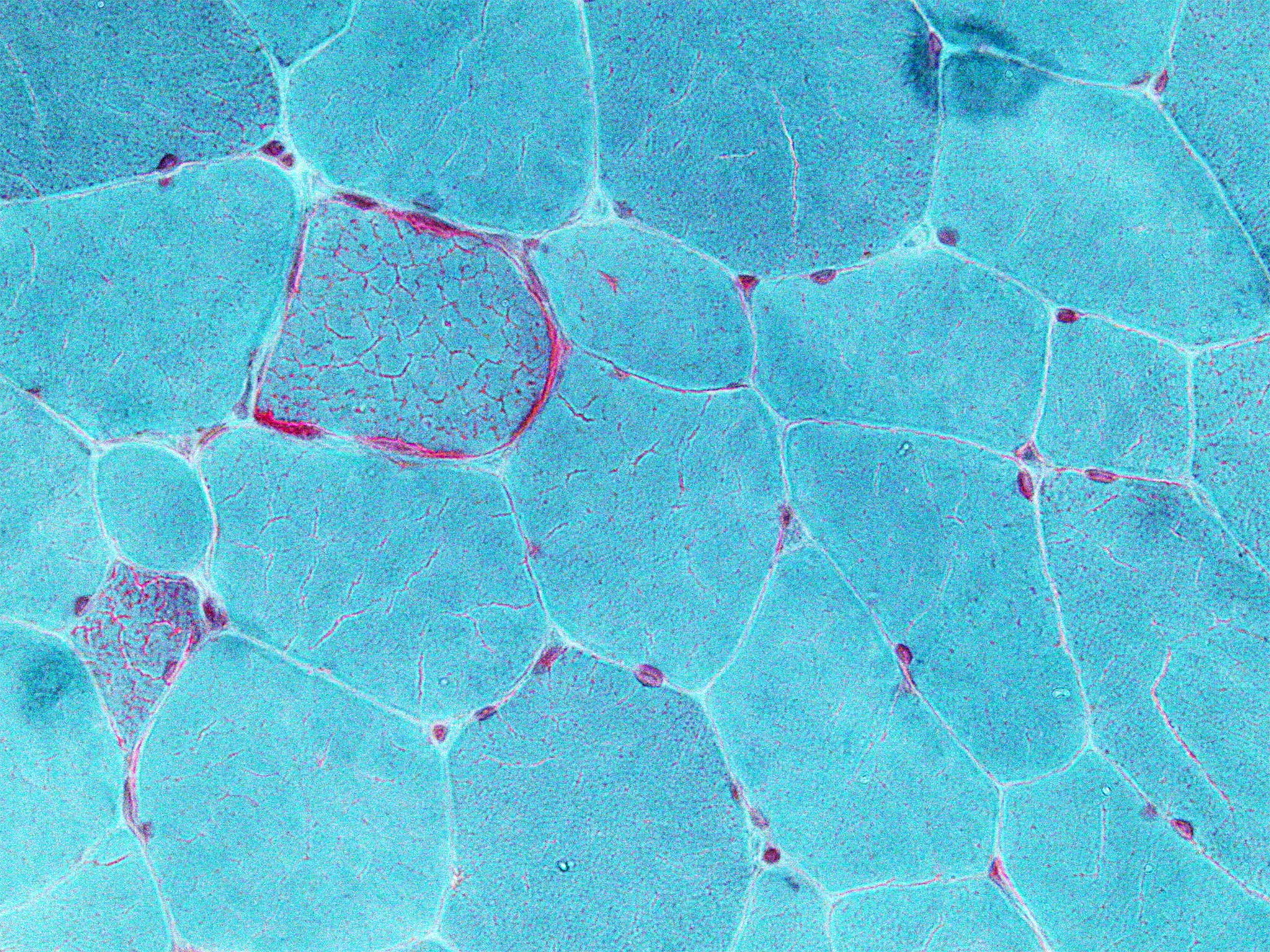 Micrograph showing ragged red fibers, a finding seen in various types of mitochondrial diseases