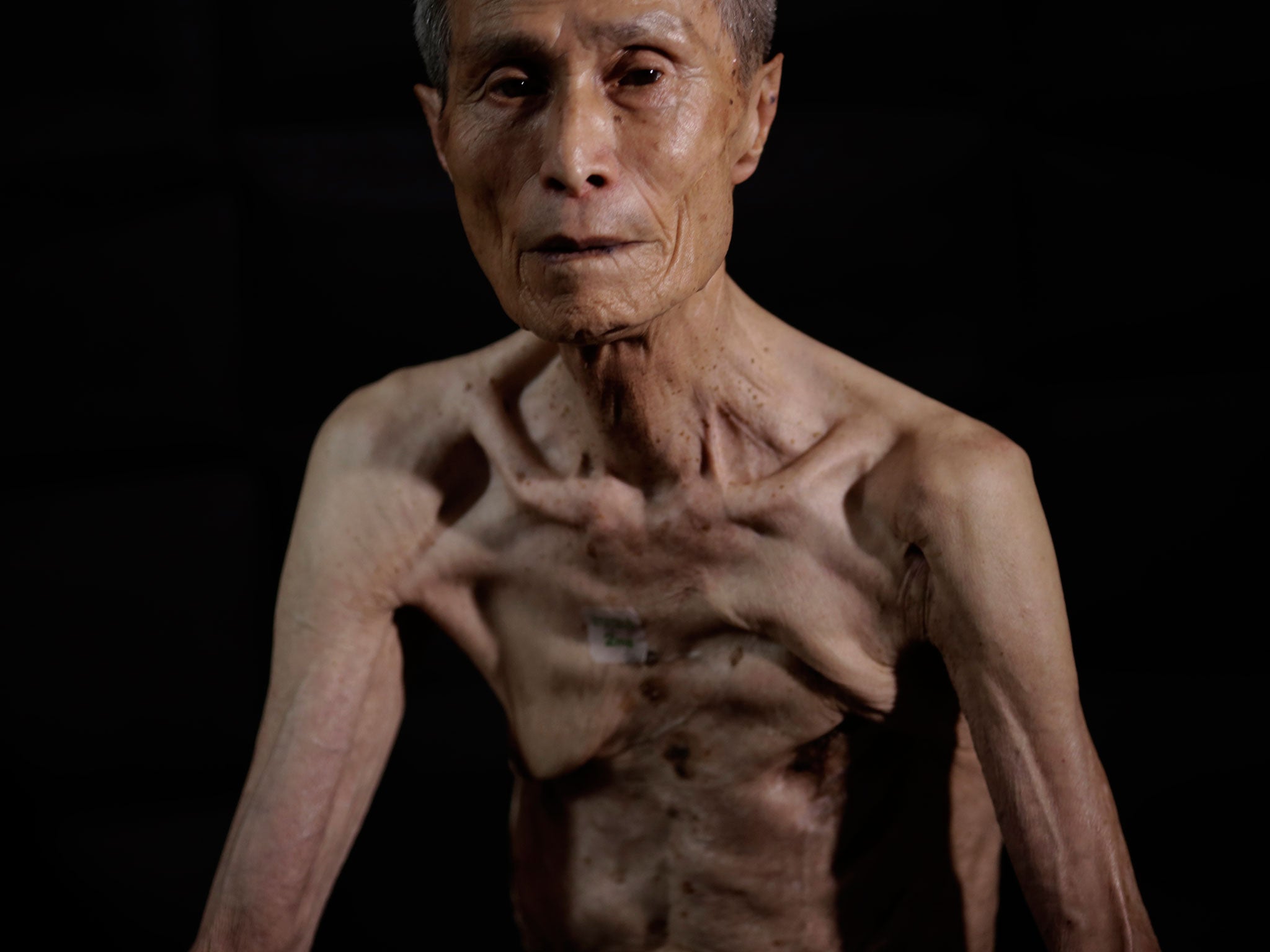 For 70 years, Taniguchi has lived with wounds covering most of his back, and the remains of three ribs that permanently press against his lungs, making it hard to breathe