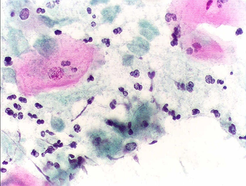 Pap smear, showing infestation by Trichomonas vaginalis