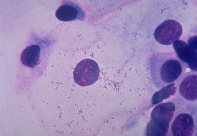 Infected urethral cells in urea plasma, from male patient with non-gonococcal urethritis.