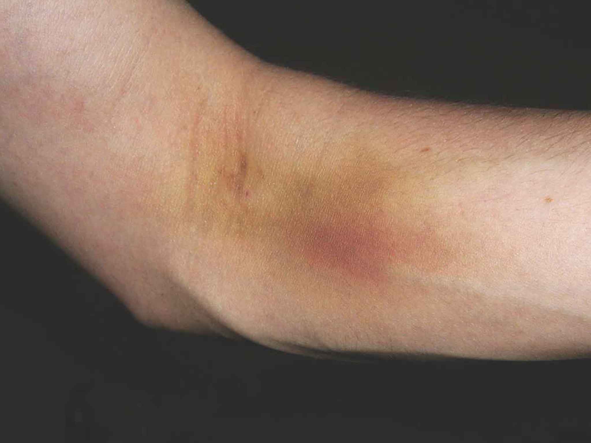 Bruises are caused by damaged capillaries under the skin