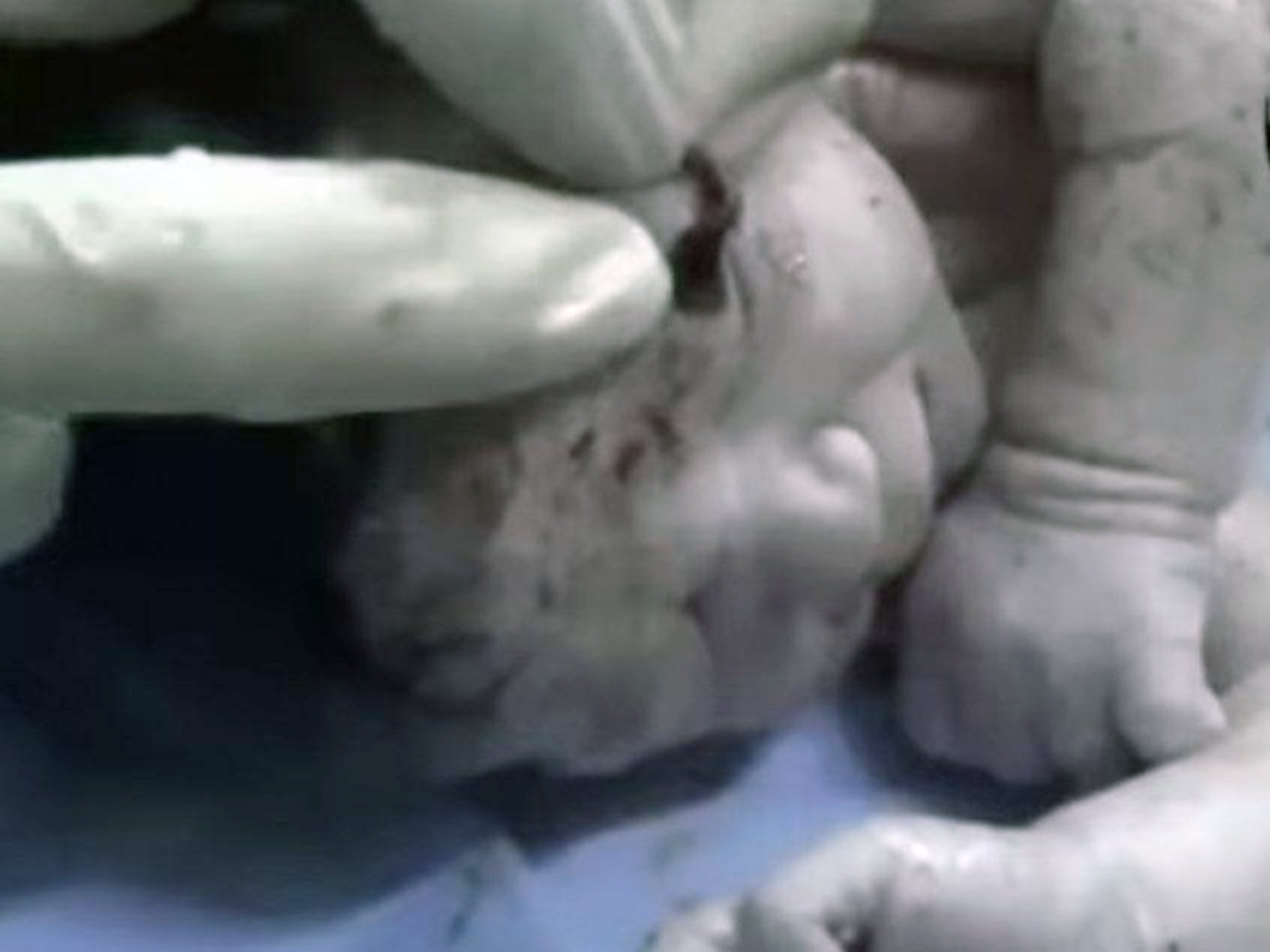 The baby survived after a video showed surgeons removing shrapnel from her head