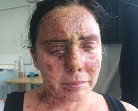 Carla Whitlock was left with horrific burns following the attack