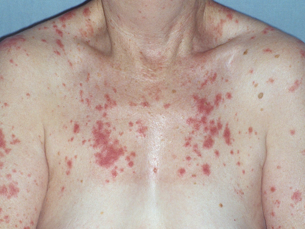 Lupus erythematosus on the skin of the chest and arms