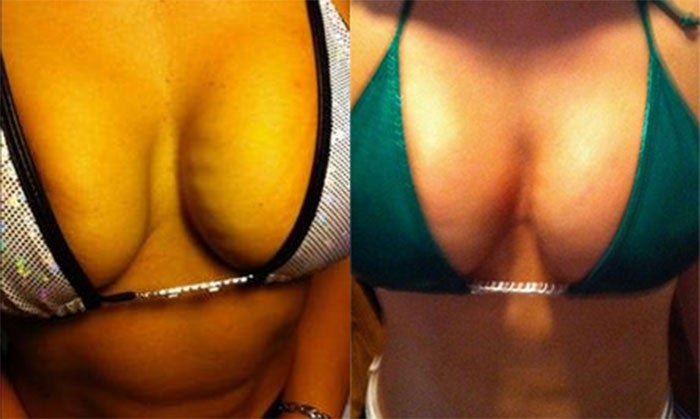 The breasts on the left are before the breast lift, the breasts on the right show the effect.