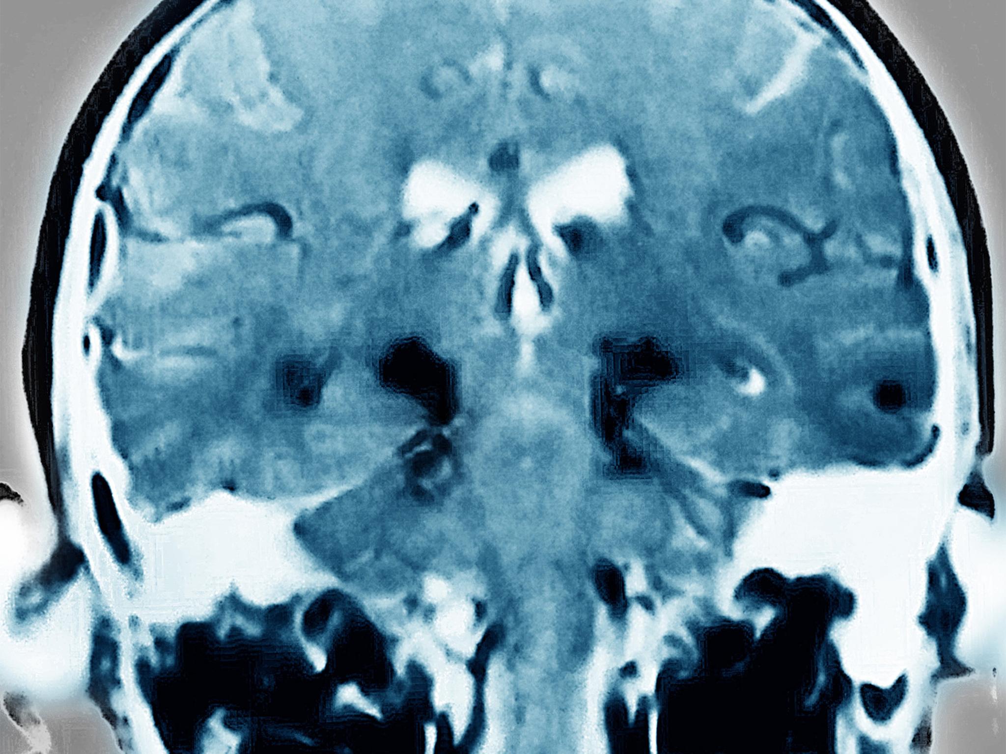 A Parkinson’s patients’ brain