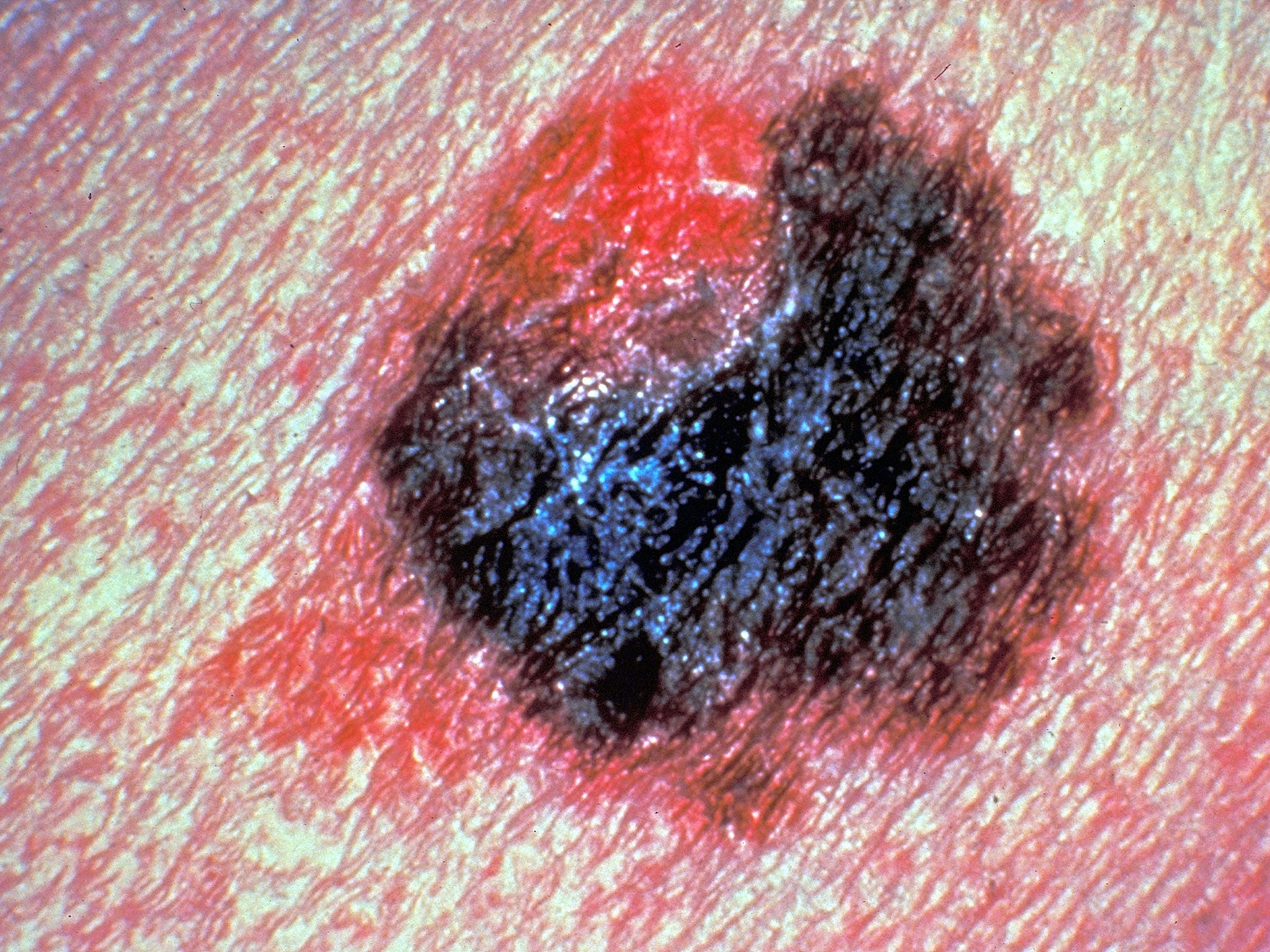 Detail of a person with a malignant melanoma