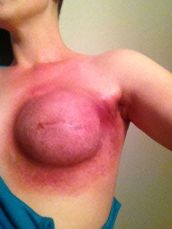 Jenn Alter's chest post-radiation treatment Tumblr