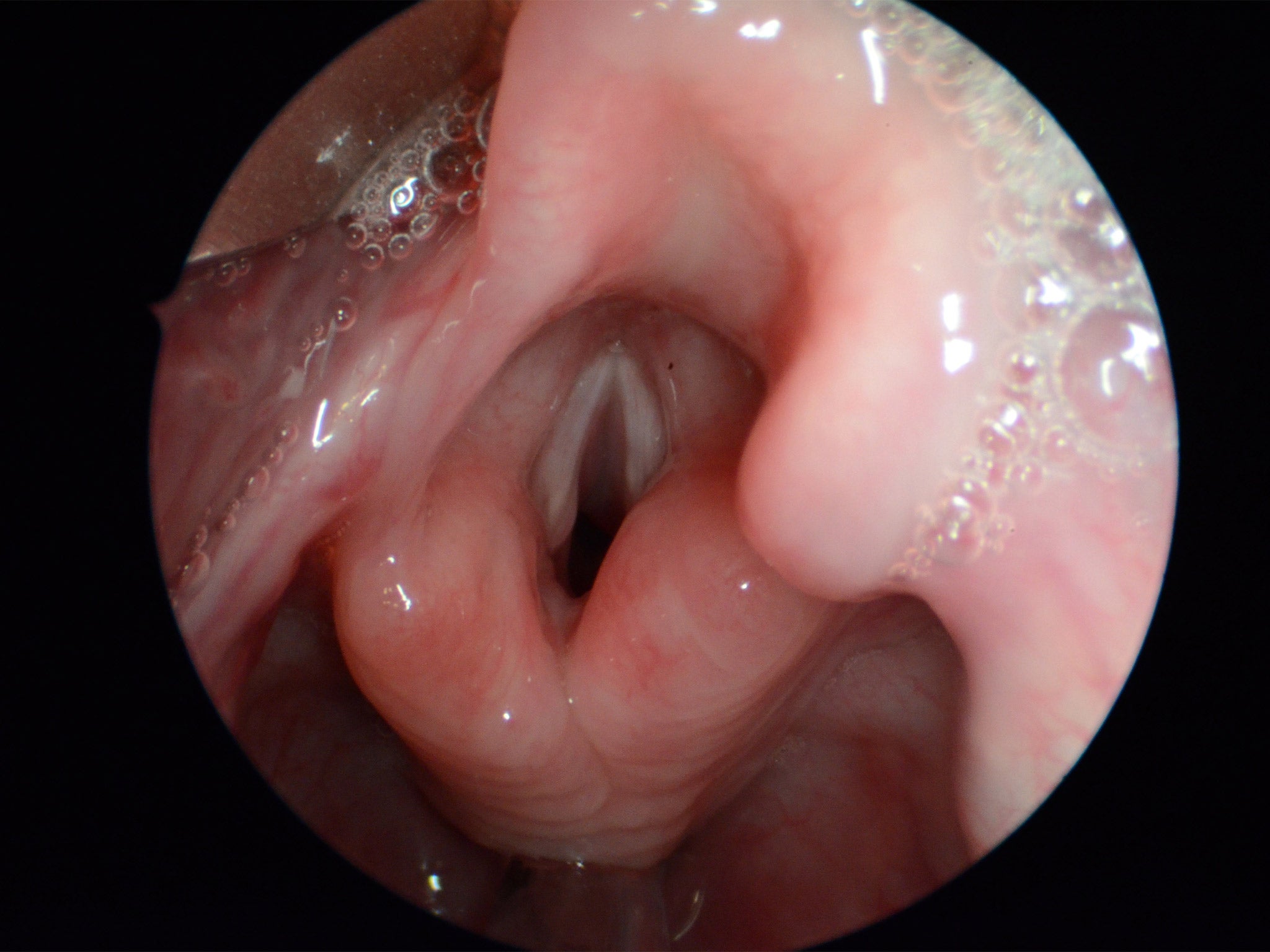 A close up view of a normal larynx and vocal folds