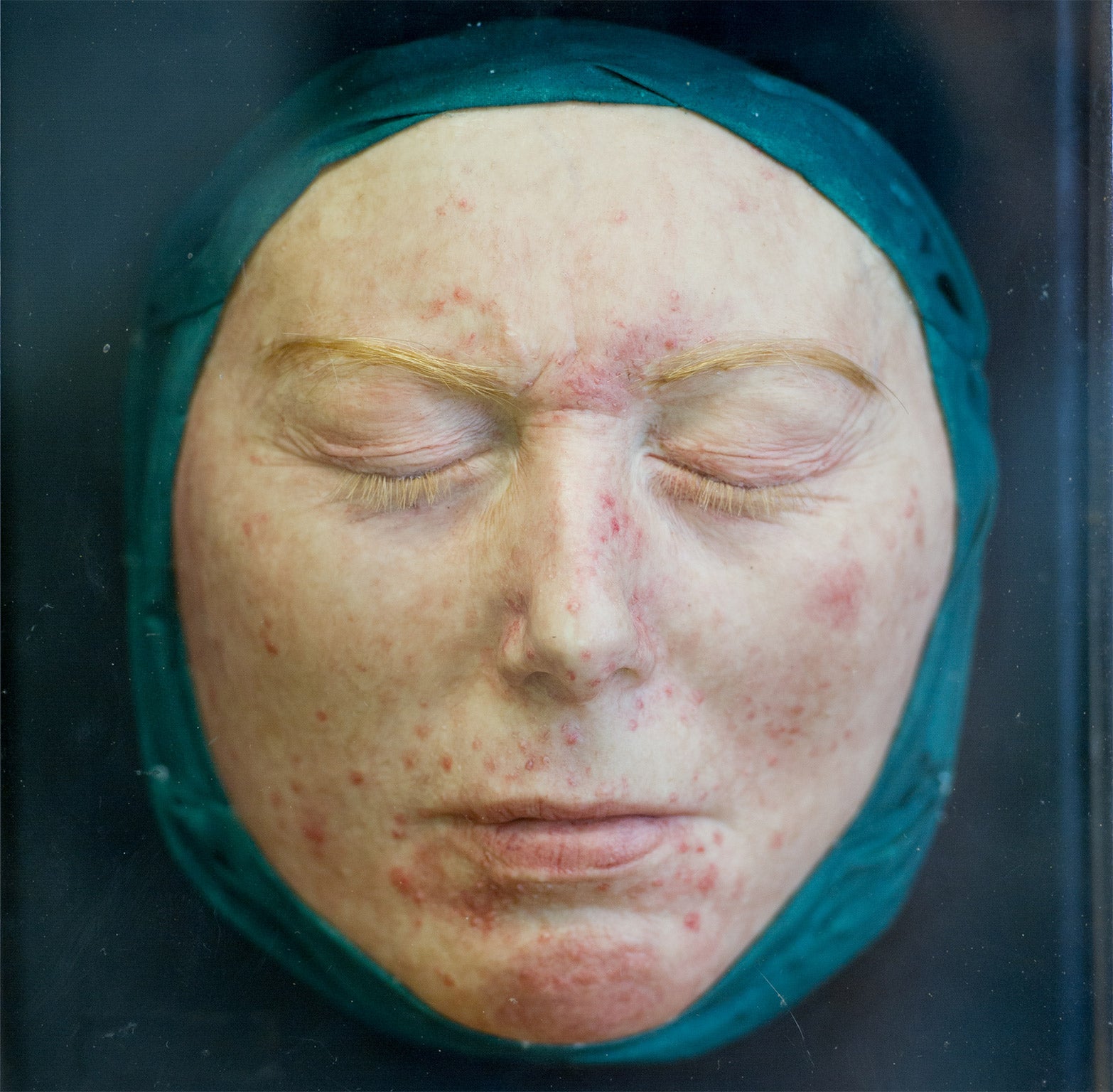 Under the skin: a picture of a patient from the book commemorating the anniversary of St John's Dermatology Unit