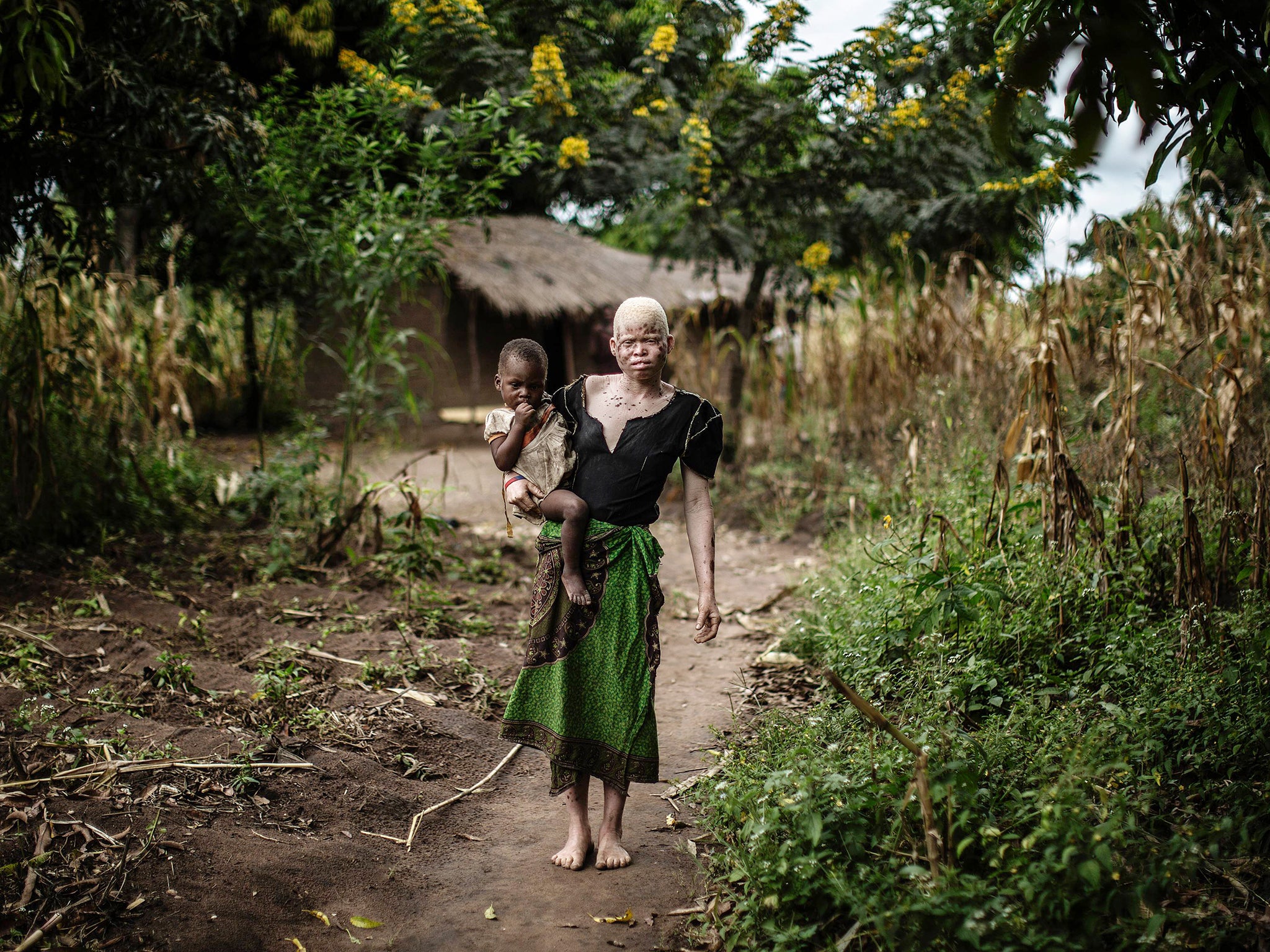 A young albino woman in Malawi, where people with albinism are often stigmatised