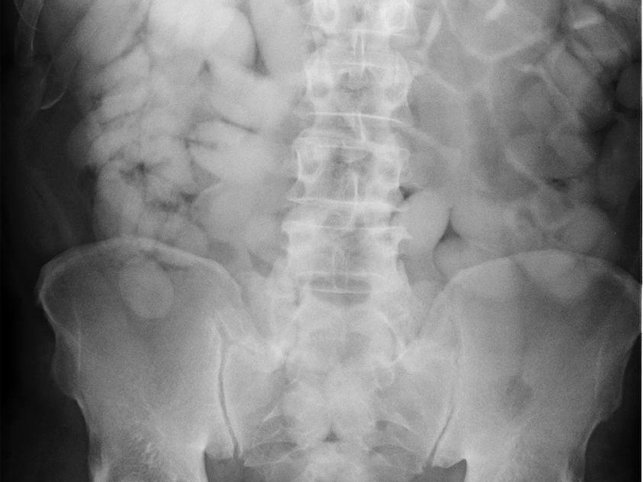 X-ray image released by the Home Office shows an individual who has swallowed parcels of drugs in a bid to smuggle them in to the country