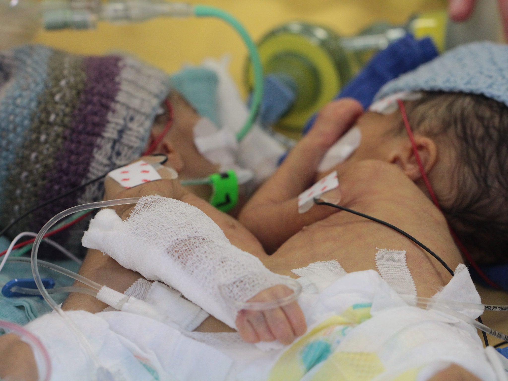 Lydia, left, and Maya before the successful operation to separate them at eight days old in Bern, Switzerland