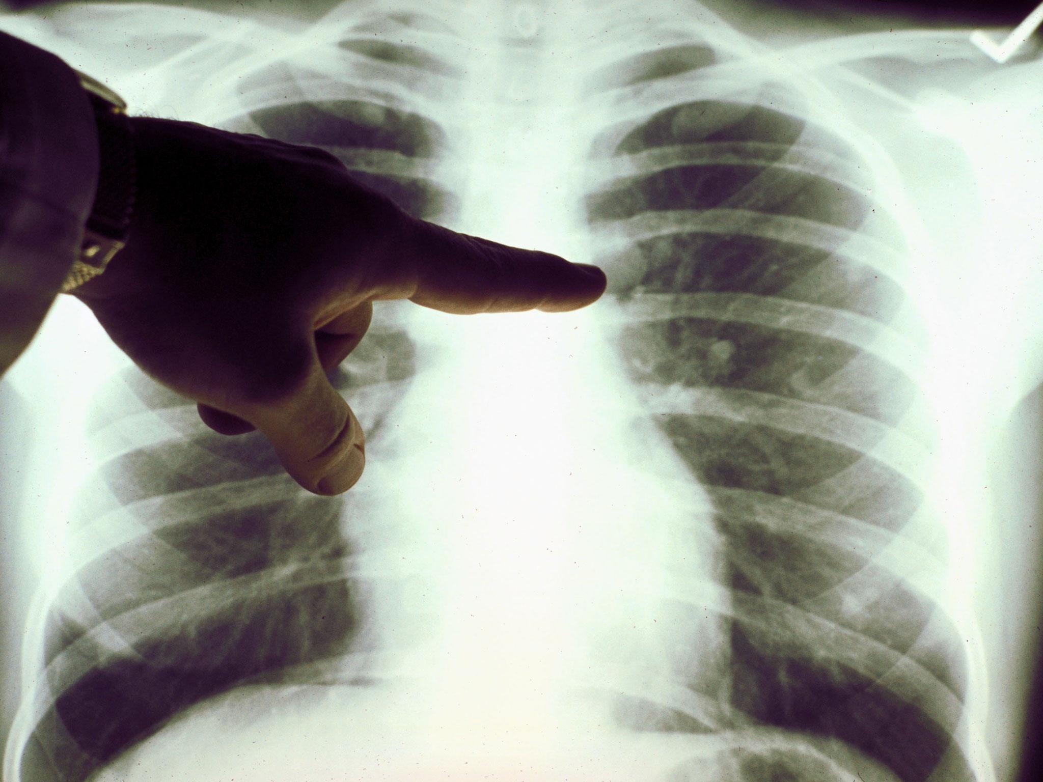 Non-smokers with lung cancer are 'disadvantaged'