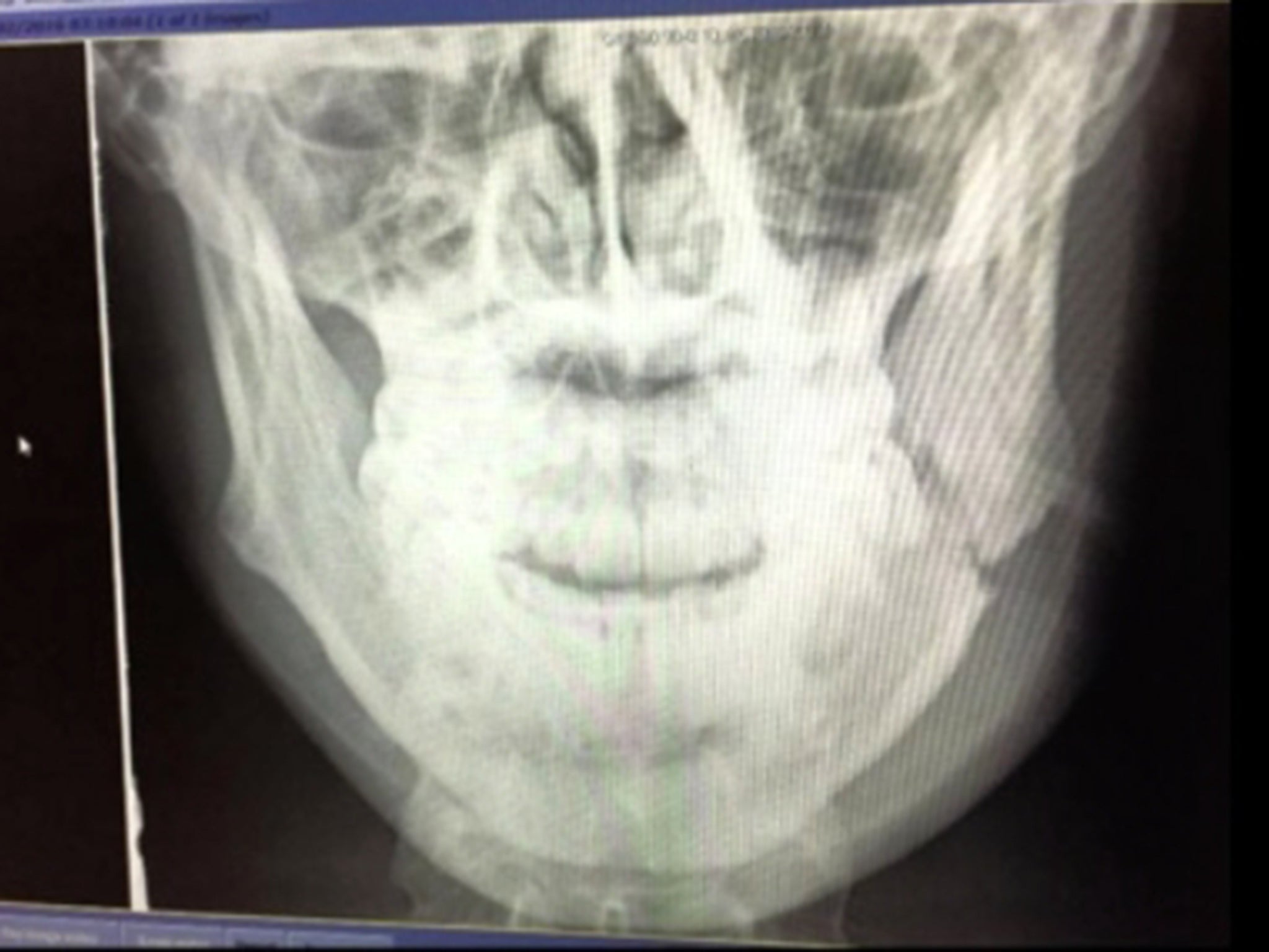 This X-ray of Scott Quigg’s jaw shows the appalling damage with which he fought on for eight grim rounds on Saturday night