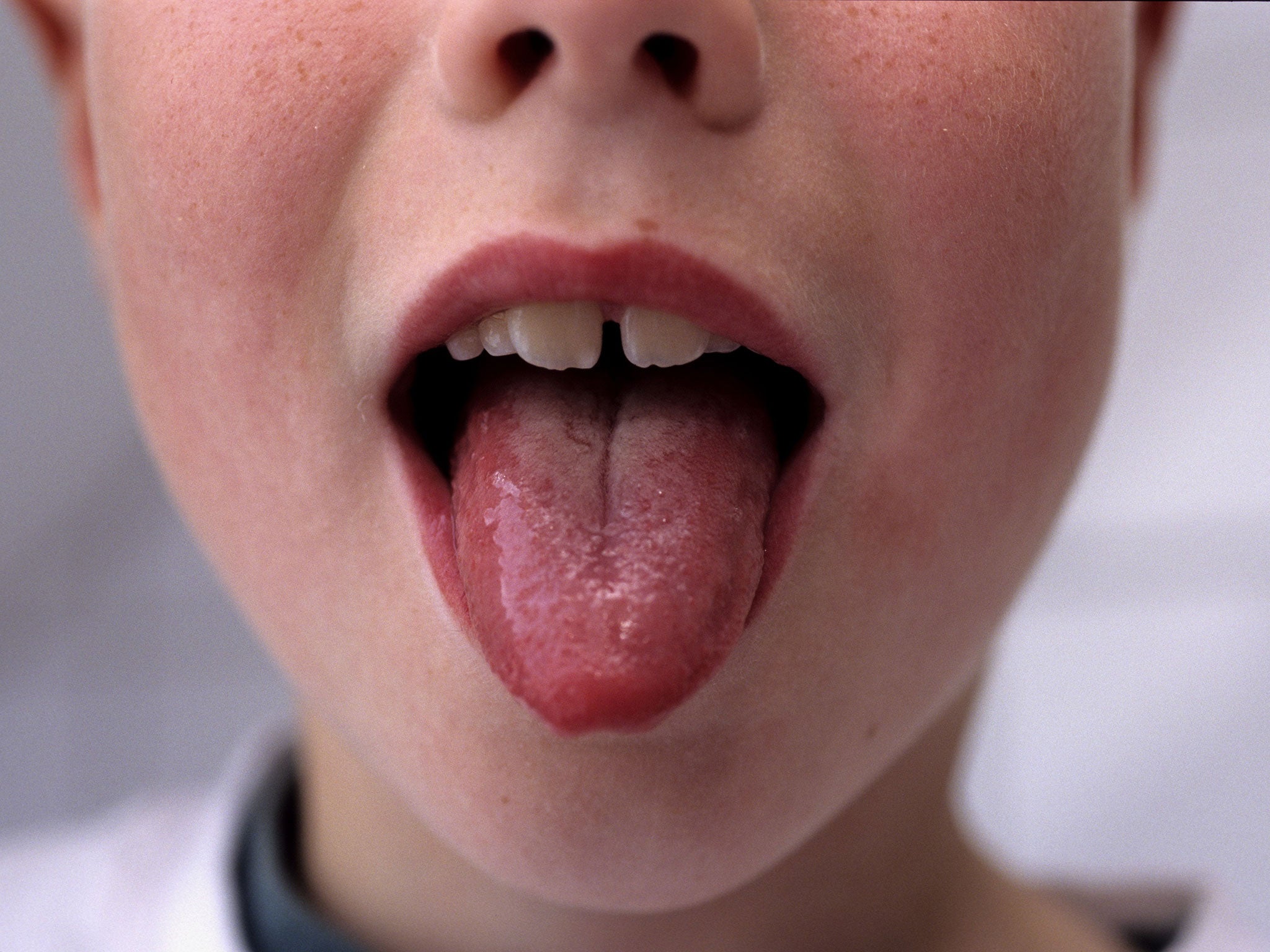 A child with scarlet fever with a swollen tongue