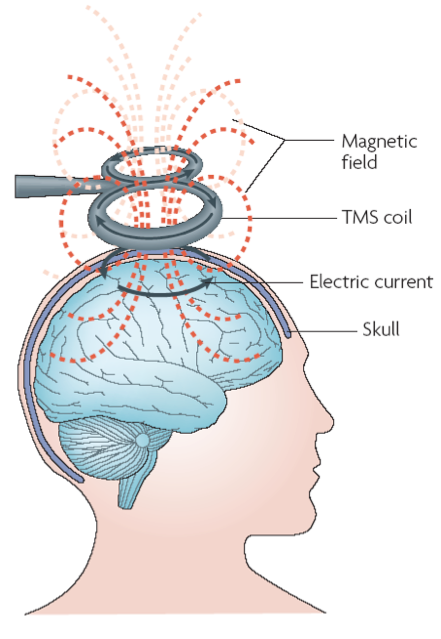 An illustration demonstrating theta-burst Transcranial Magnetic Stimulation