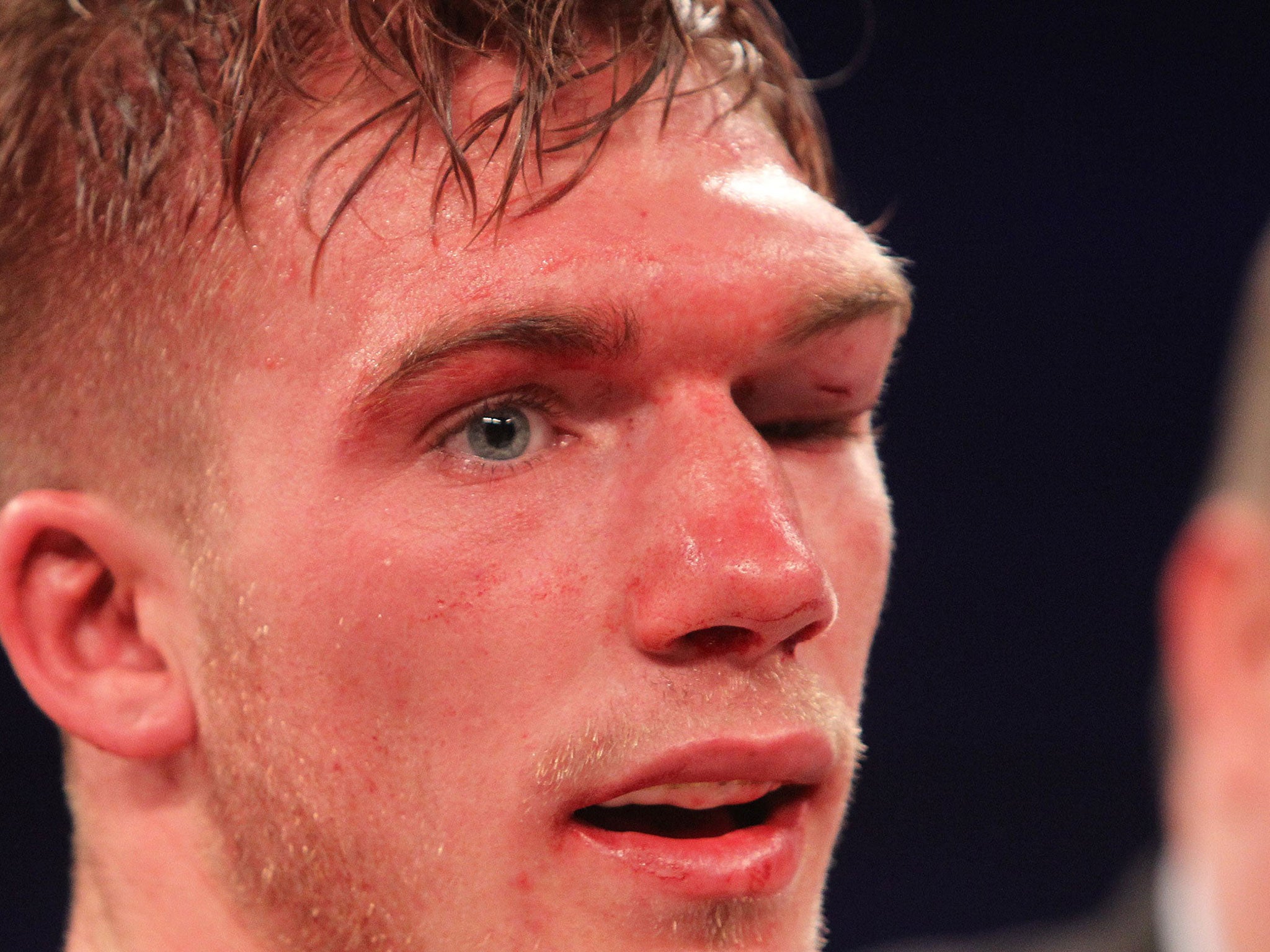 Nick Blackwell's eye injury during his fight with Chris Eubank Jnr