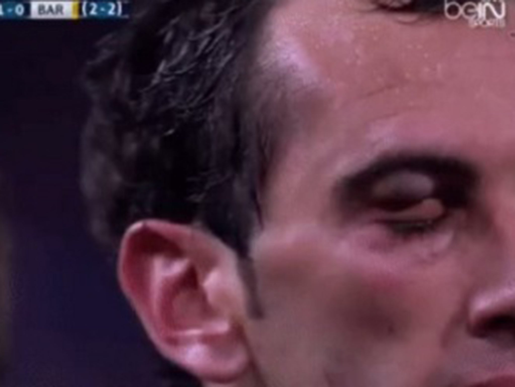 Diego Godin's eye after the Luis Suarez clash