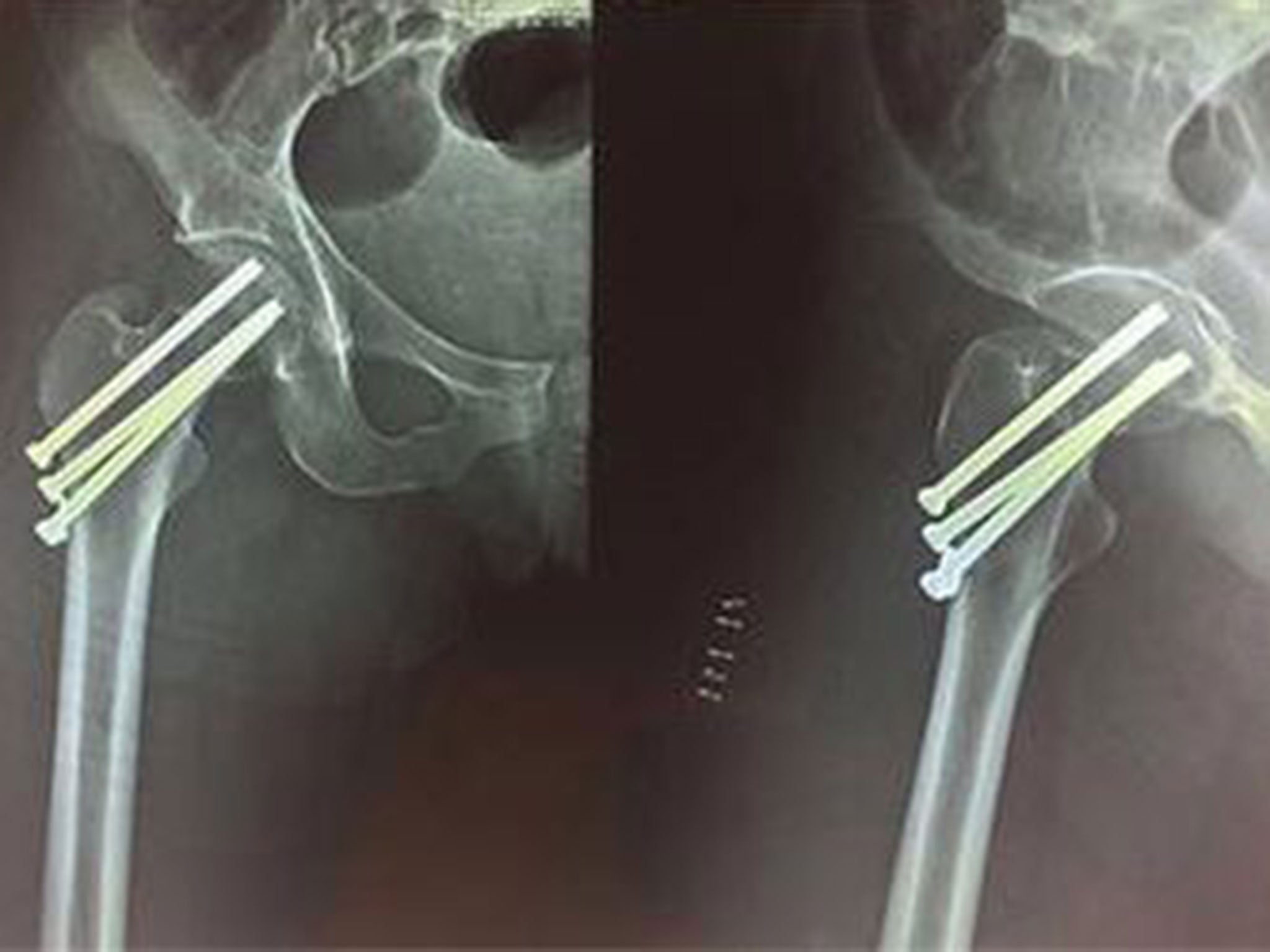 Zoe Schaffer-Jennett had three screws screws inserted to reattach the femoral head during a four-hour long operation