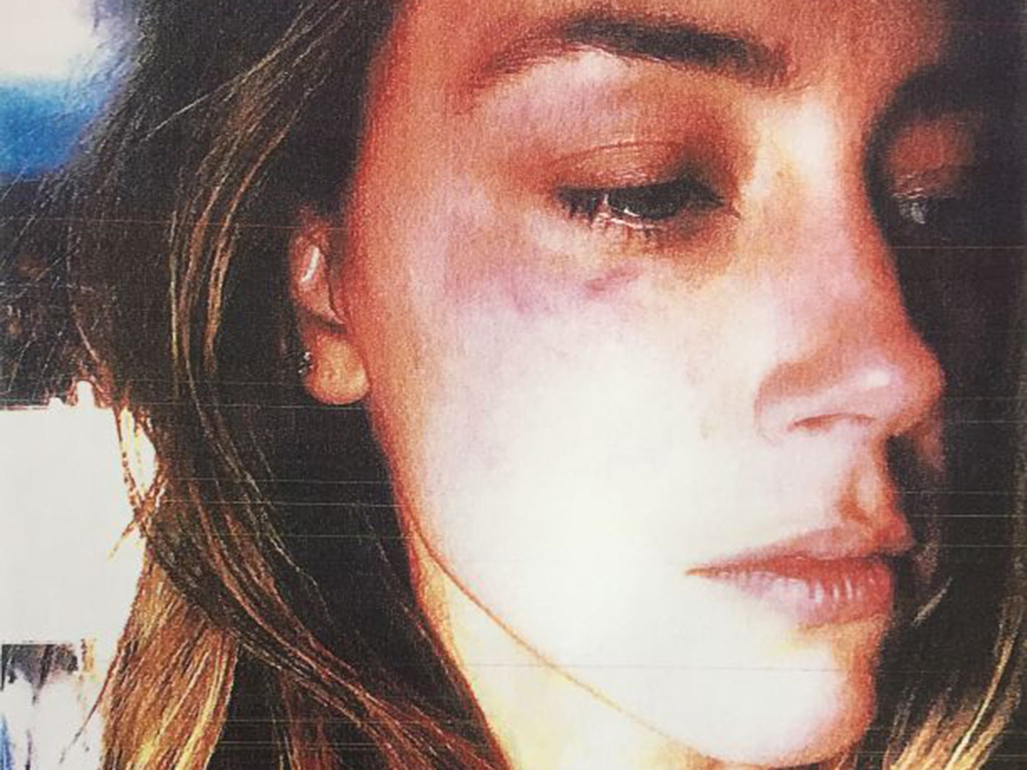 An undated picture of Amber Heard, apparently showing bruising to the right side of her face