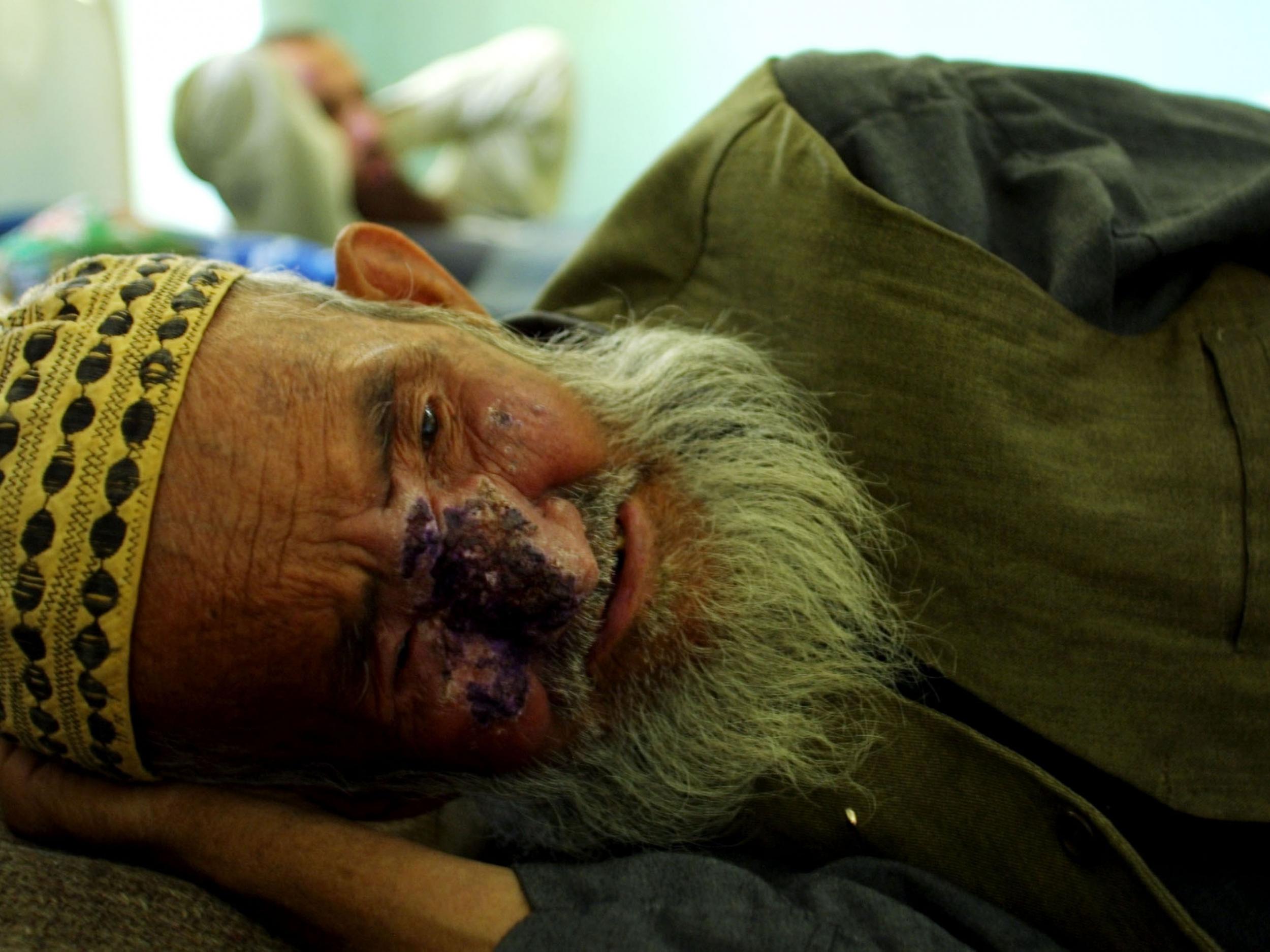 A man suffering from Cutaneous Leishmaniasis (Getty Images )