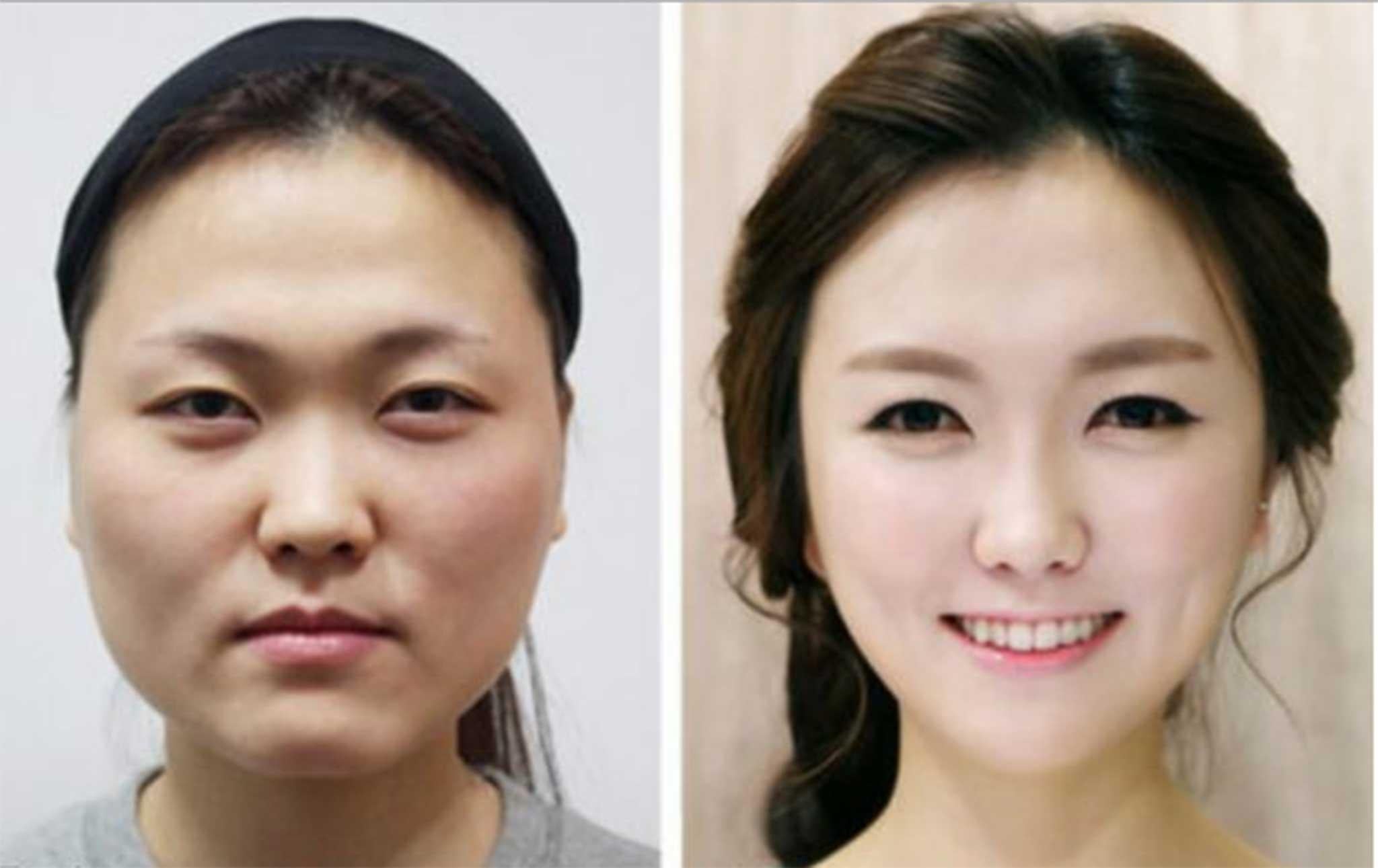 In South Korea, facial procedures aimed at achieving a more ‘Western’ appearance are increasingly commonplace