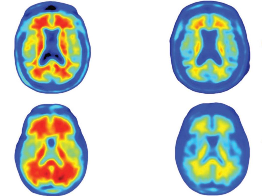 Brain scans highlighting the deposits of amyloid plaques in Alzheimer’s patients