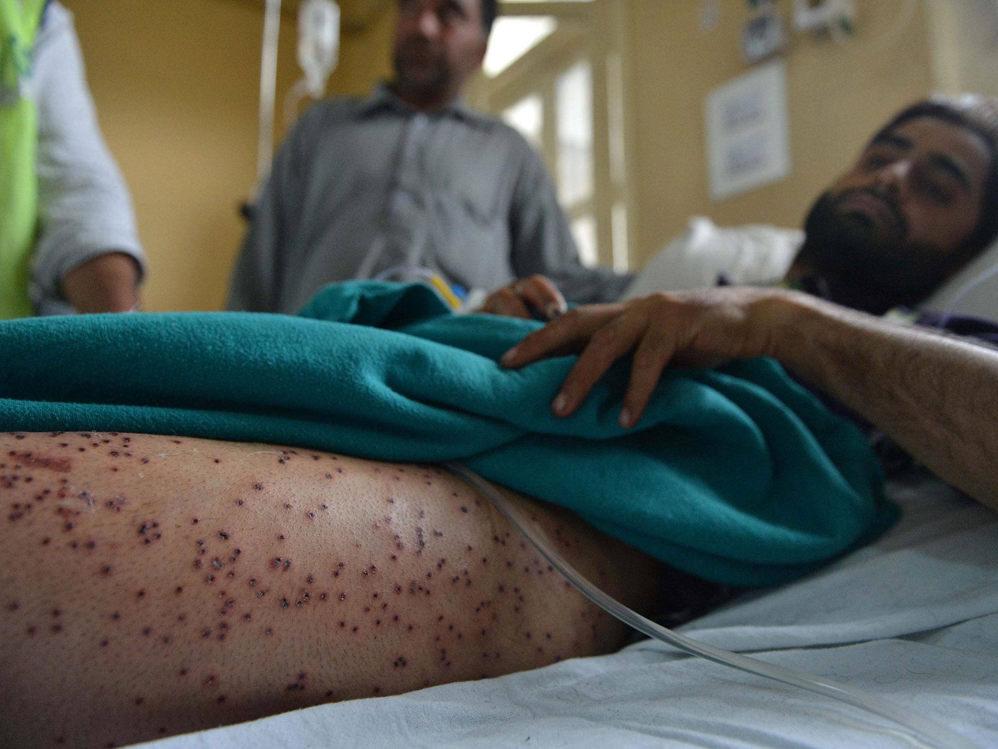A wounded Kashmiri muslim lies on a hospital bed at a hospital in Srinagar, after being hit by pellets fired by Indian security forces during a protest