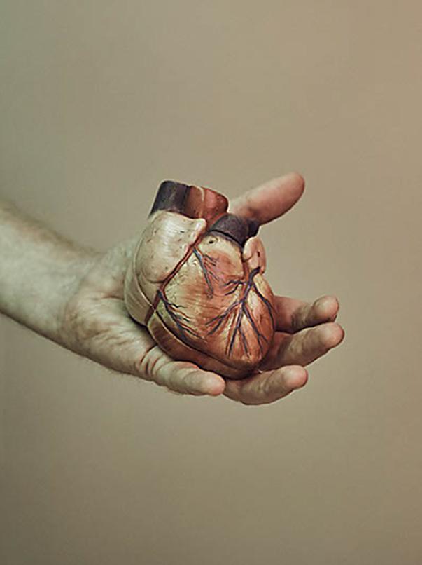 Marfan syndrome is a disorder of the body’s connective tissues and can be deadly if the heart becomes affected