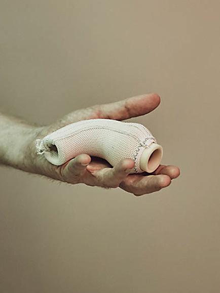 Golesworthy’s sleeve invention aims to halt the dangerous expansion of the aortic root