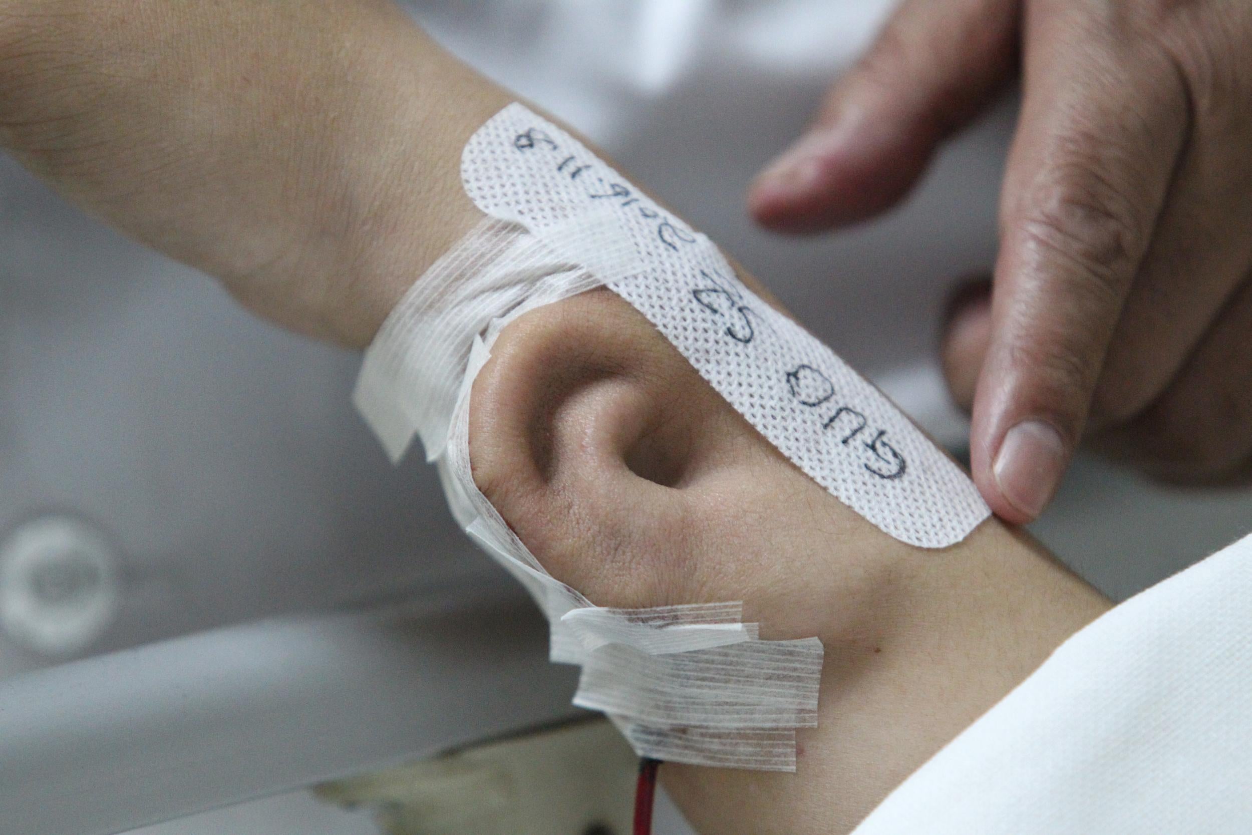 An "ear" is seen growing on the arm of a patient who lost his right ear in an accident, at the first affiliated hospital of Xi'an Jiaotong University, in Xi'an, Shaanxi province, China, November 9, 2016